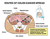 Colon cancer spread, illustration