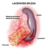 Lacerated spleen, illustration