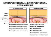 Ventral hernia repair, illustration