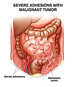 Severe adhesions from malignant tumour, illustration