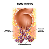 Haemorrhoids, illustration