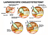 Laparoscopic cholecystectomy, illustration