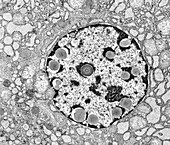 Hepatocyte with nuclear inclusion bodies, TEM
