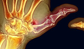 Osteoarthritis of the thumb, X-ray