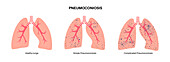 Pneumoconiosis lung disease, illustration