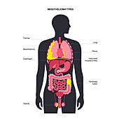 Mesothelioma tumour types, illustration