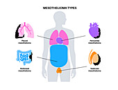 Mesothelioma tumour types, illustration