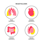 Mesothelioma tumour types, illustration