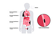 Mesothelioma tumour types, illustration