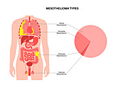 Mesothelioma tumour types, illustration