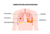 Asbestos related diseases, illustration