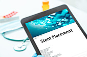 Stent placement