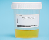 Urine 5-HIAA test