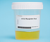 Urine myoglobin test