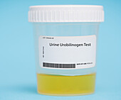 Urine urobilinogen test