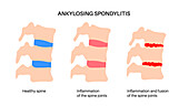 Ankylosing spondylitis, illustration