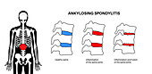 Ankylosing spondylitis, illustration