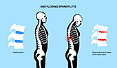 Ankylosing spondylitis, illustration