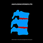 Ankylosing spondylitis, illustration