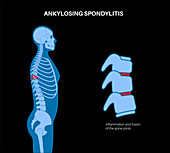 Ankylosing spondylitis, illustration