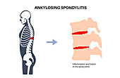 Ankylosing spondylitis, illustration