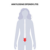 Ankylosing spondylitis, illustration