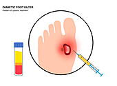 Diabetic foot syndrome treatment, illustration