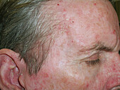 Seborrheic dermatitis