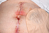 Infected wound following surgery on a woman's abdomen