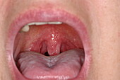 Streptococcal tonsillitis in a woman's throat
