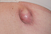 Infected sebaceous cyst on a woman's back