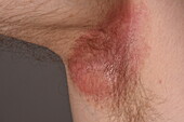Psoriasiform eczema on a man's armpit