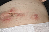 Allergic reaction to wound dressing in female patient