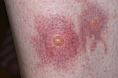Reaction to mosquito bites on a woman's leg