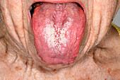 Thrush on a woman's tongue