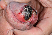 Necrosis on penis in male patient with calciphylaxis
