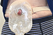 Urostomy bag following cancer surgery