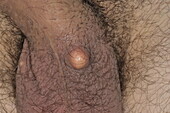 Cyst on a scrotum in a male patient