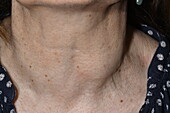 Multinodular goitre of thyroid in female patient