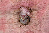 Thrombosed hemangioma on a man's back