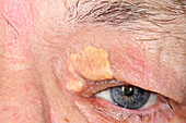 Xanthelasma in a male patient