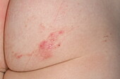 Cutaneous larva migrans infection on a girl's buttock