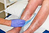 Leg dressing in patient with varicose eczema