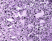 Lymph node anthracosis, light micrograph