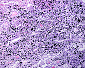 Lymph node anthracosis, light micrograph