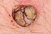 Seborrhoeic keratosis in a male patient