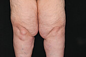 Lipoedema in a woman's legs