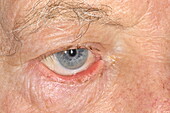 Ectropion in a man's eyelid