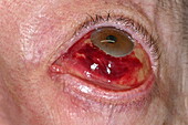 Subconjunctival haemorrhage in a woman's eye