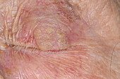 Seborrhoeic keratosis on a woman's eyelid